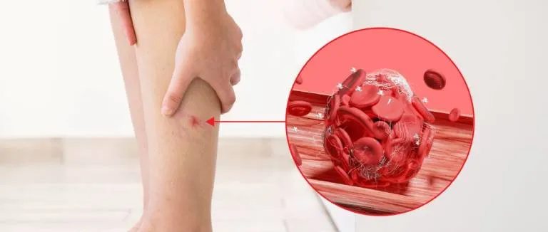 Kıl Kökü İltihabı Tedavisi