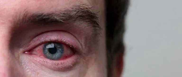 Kırmızı Göz Hastalığı (Konjonktivit) Nedir?