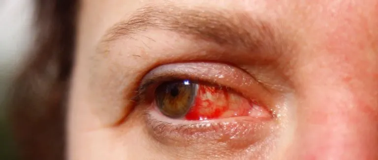Kırmızı Göz Hastalığı Türleri Nelerdir?