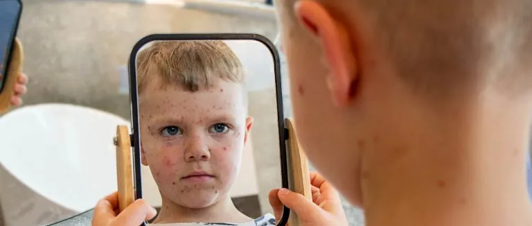 Kızamık Nedir? Kızamık Belirtisi ve Tedavisi