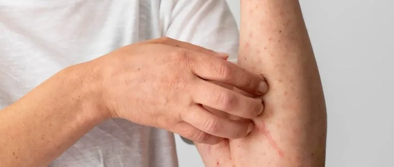 Kızamık Belirtileri