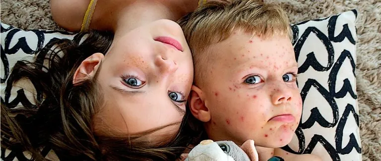 Kızamığa Ne İyi Gelir?