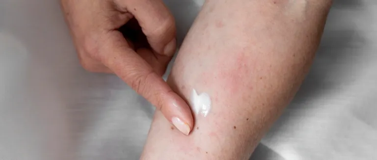 kronik-urtiker-tedavisi