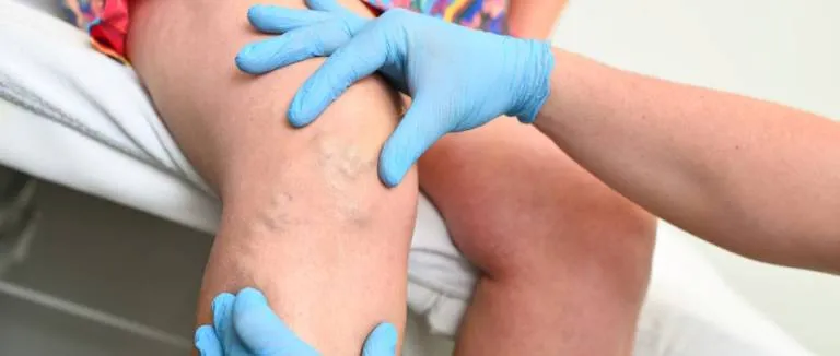 kronik-venoz-yetmezlik-tedavisi