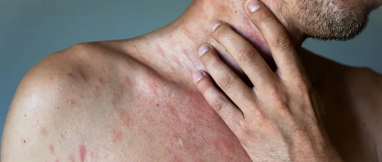 Kurdeşen Belirtileri