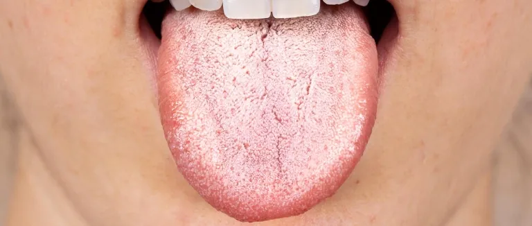 Dil Kuruması Nedir? Neden Olur?