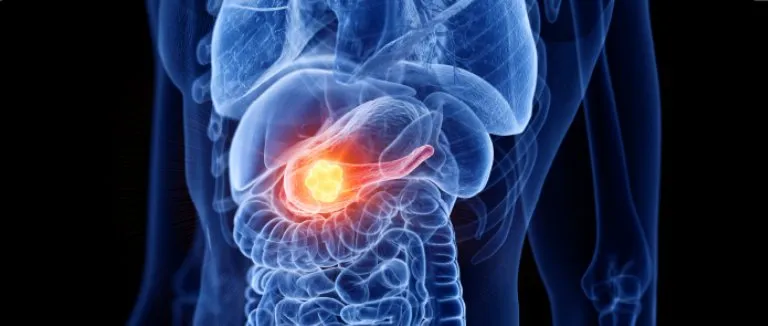 le diagnostic-precoce-est-le-point-cle-du-traitement-du cancer-du-pancreas