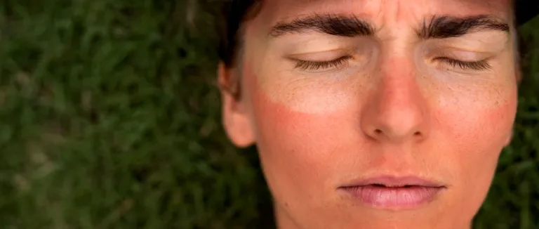 Güneş Lekesi Nasıl Geçer?