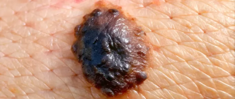 Malign Melanom tipleri