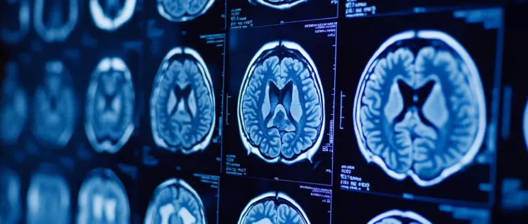 What You Should Know About Meningioma Surgery