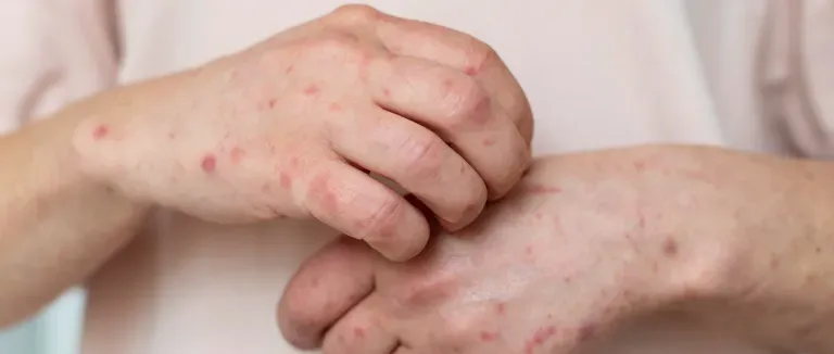 What is Monkeypox Virus?