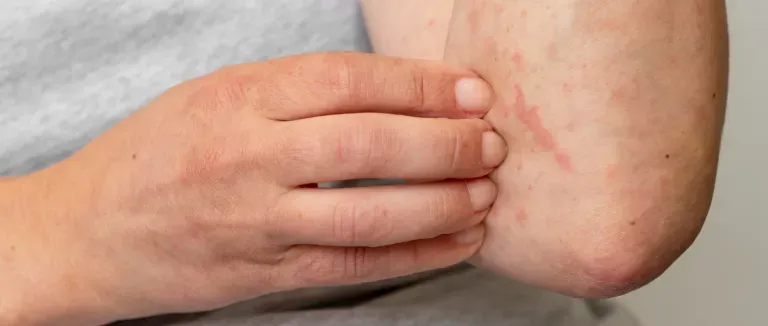 What are the Risks of Monkeypox Transmission