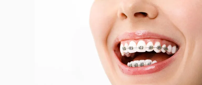 Benefits and Process of Orthodontic Treatment