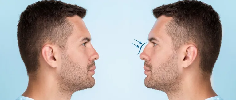 piezo-ultrasonic-rhinoplasty 2