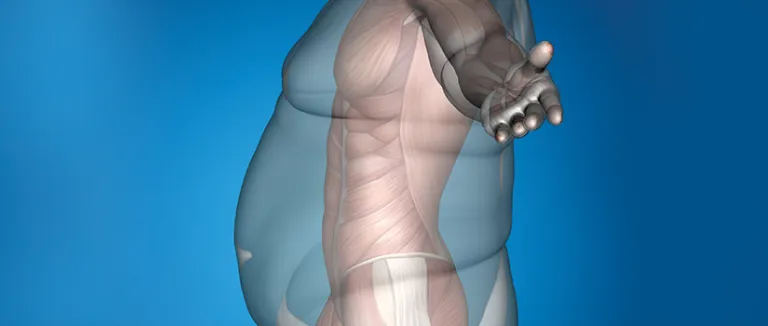 Rebirth with Obesity Surgery