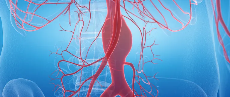 Scalpel-Free Treatment for Brain Aneurysms