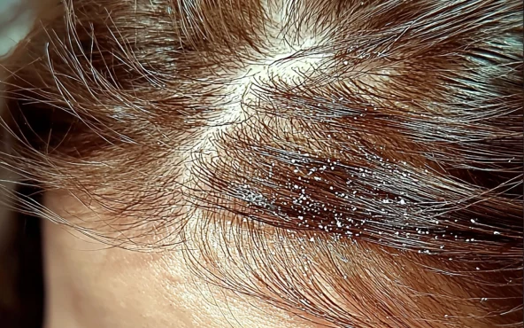 Seboreik Dermatit (Yağlı Egzama)