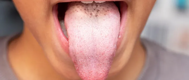 Sicca Sendromu Teşhisi ve Tedavisi