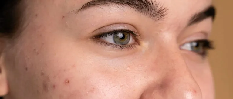 Sivilce (Akne) Tedavisi