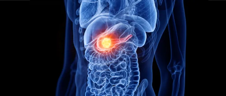 The Key Point in Pancreatic Cancer Treatment is Early Diagnosis.
