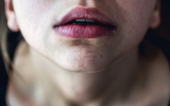 Uçuk (Herpes Simpleks)