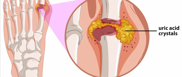 Ürik Asit Yüksekliği Neden Olur?