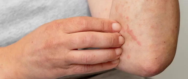 Uyuz Hastalığı Nedir?