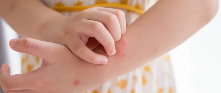 Uyuz Hastalığı Belirtileri