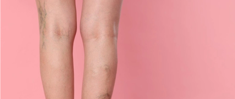 Varis Ameliyatı Nedir?