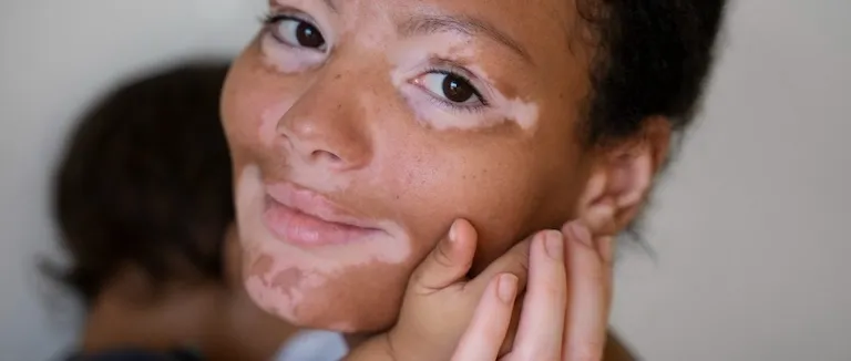 Vitiligo neden olur?