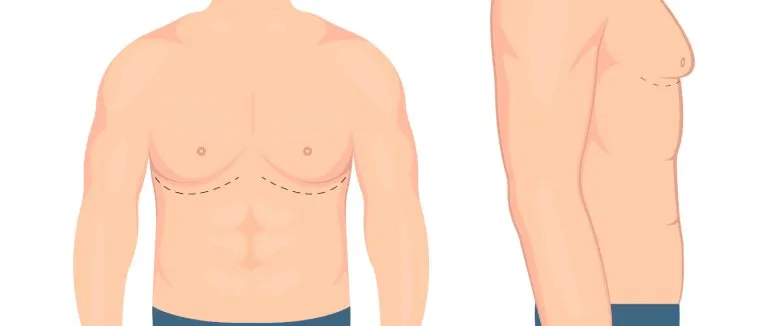 Что такое гинекомастия?