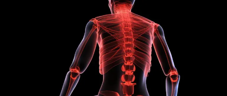 What is Cervical Kyphosis
