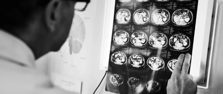 what-is-parkinsons-disease3