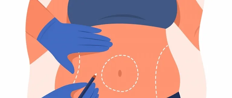 what-is-sleeve-gastrectomy