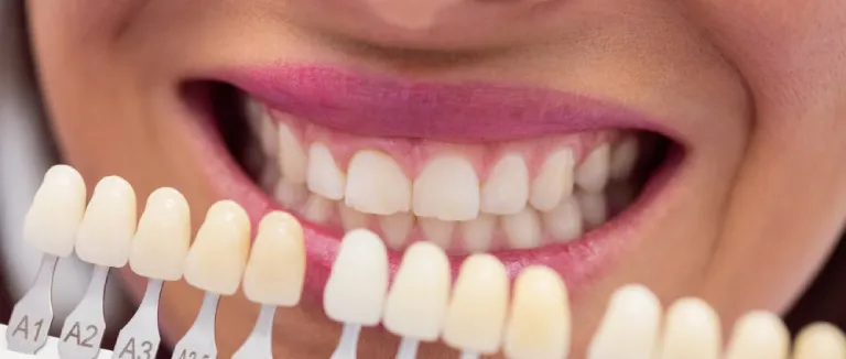 Zirconium Veneer in Turkey