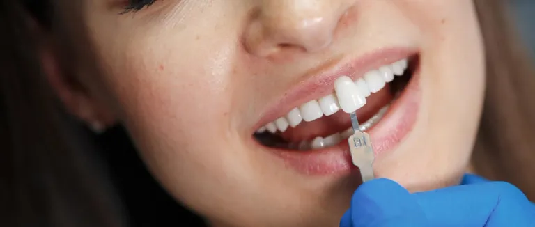 What Should Be Paid Attention to After Zirconium Veneer